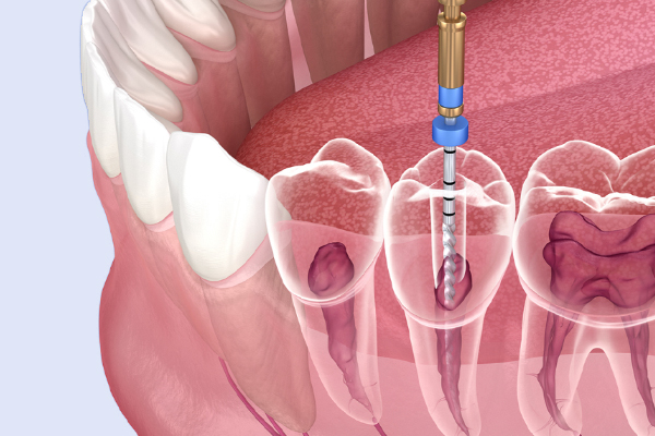 Kanal Tedavisi (Endodonti)